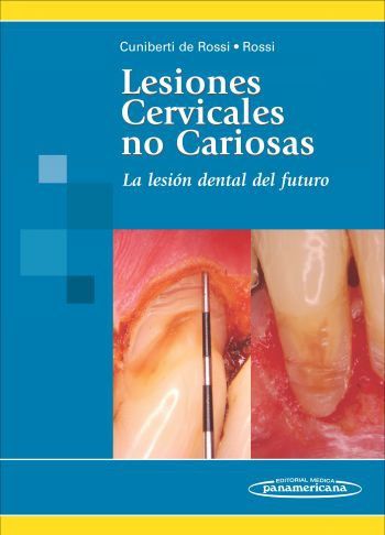 cel-lesiones-cervicales-no-cariosas-panamericana-