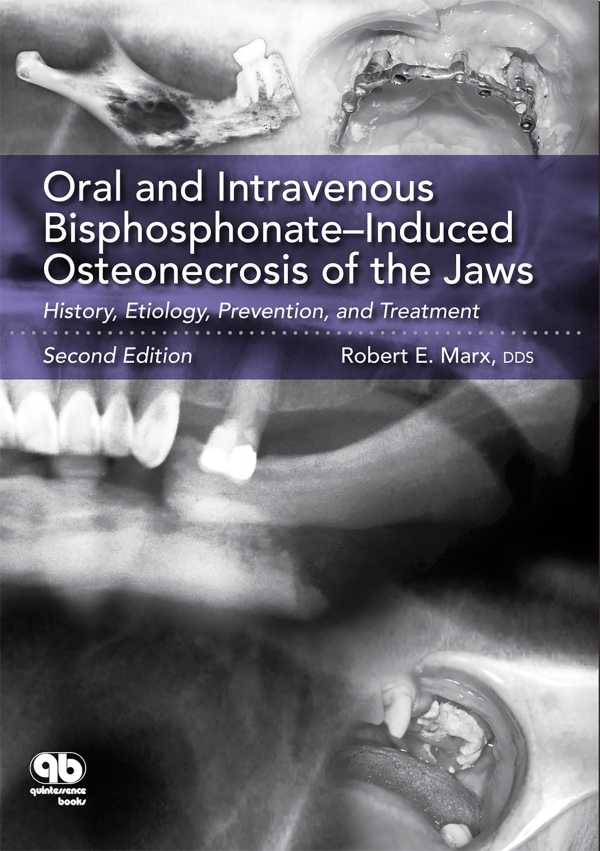 bw-oral-and-intravenous-bisphosphonatendashinduced-osteonecrosis-of-the-jaws-quintessence-publishing-co-inc-9780867159004