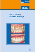 bw-dental-bleaching-quintessence-publishing-co-ltd-9781850973195