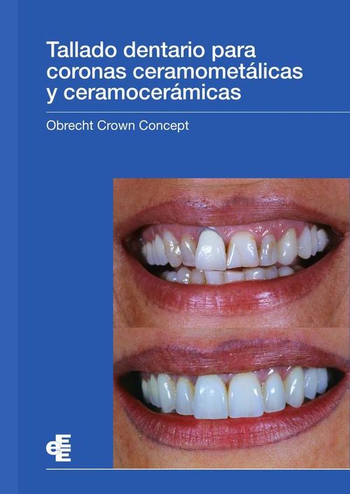Tallado dentario para coronas ceramometalicas y ceramoceramicas