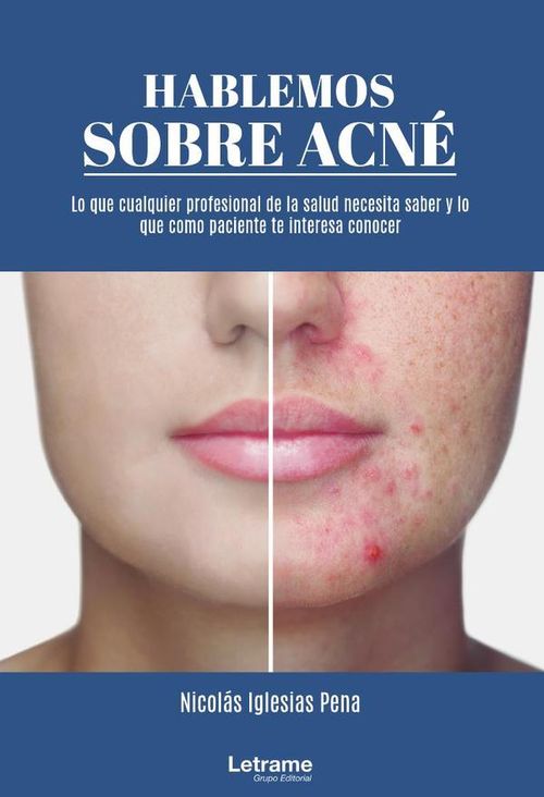 Hablemos sobre acne