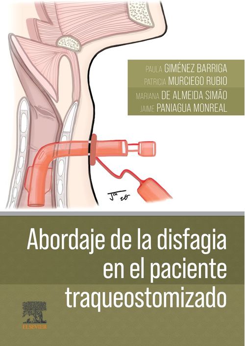ABORDAJE DE LA DISFAGIA EN EL PACIENTE TRAQUEOSTOMIZADO