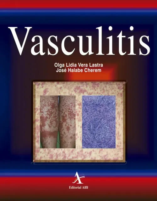 Vasculitis